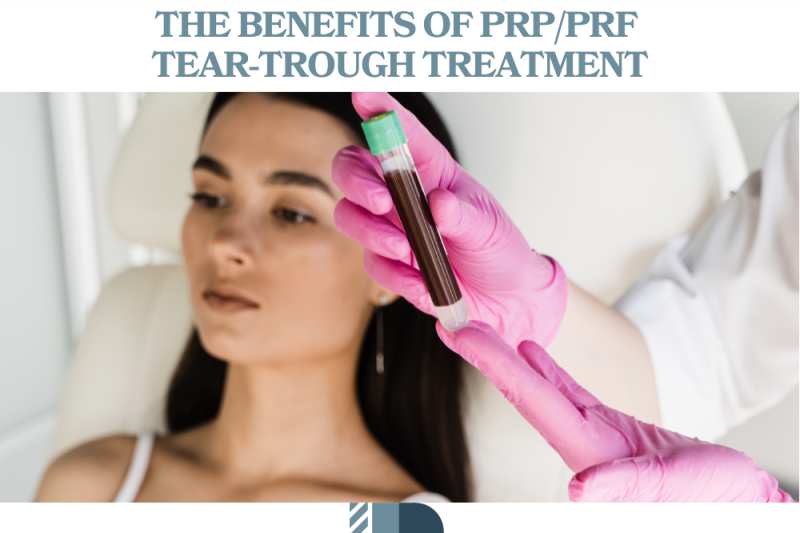 The Benefits of PRPPRF Tear-Trough Treatment